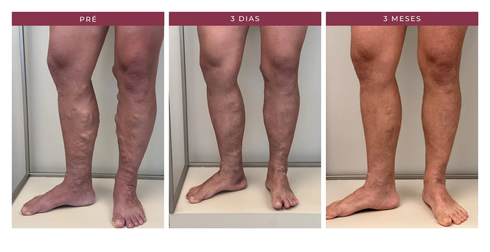 Paciente Marcos — pré, 3 dias e 3 meses, ângulo 3