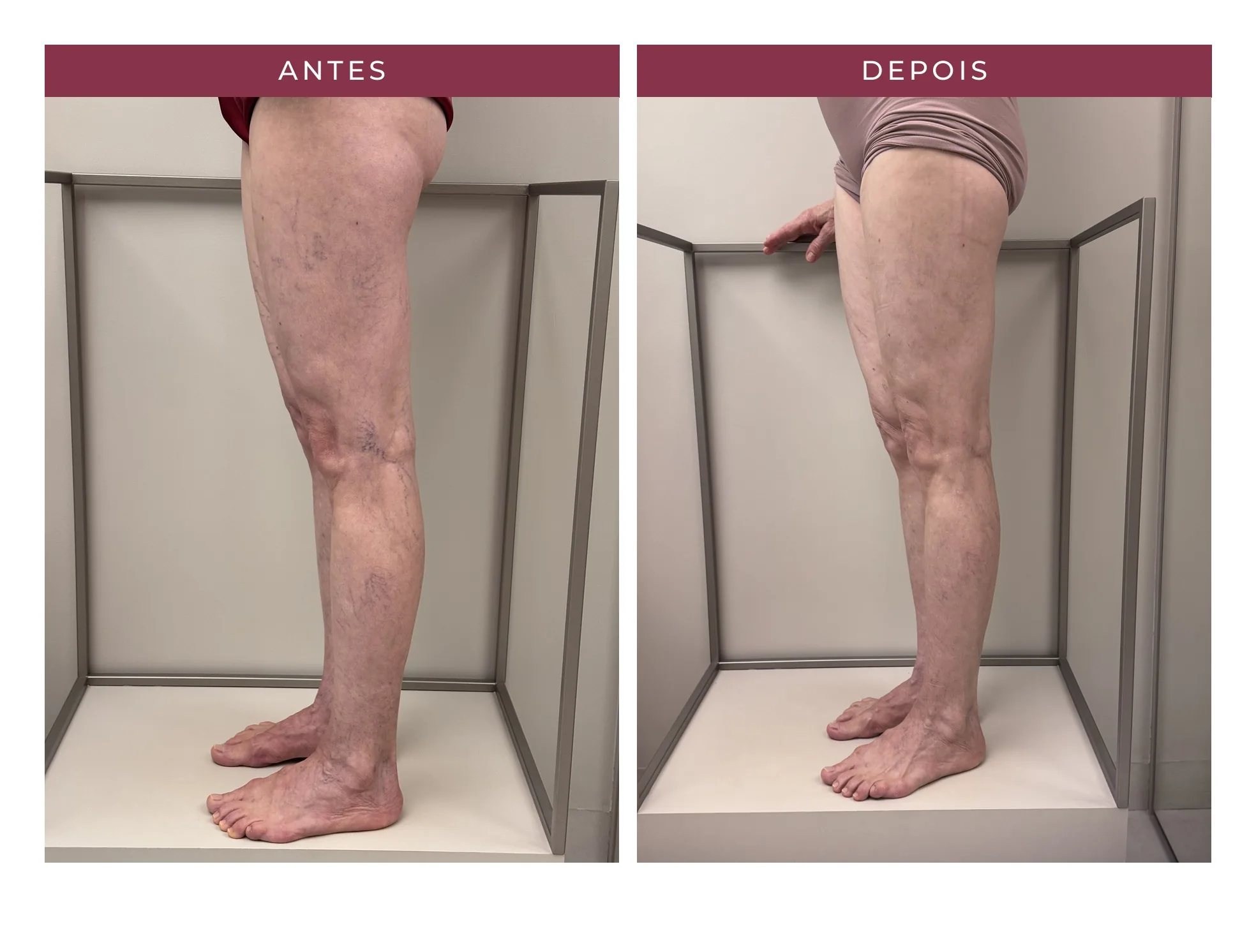 Paciente Eliene — antes e depois, ângulo 2