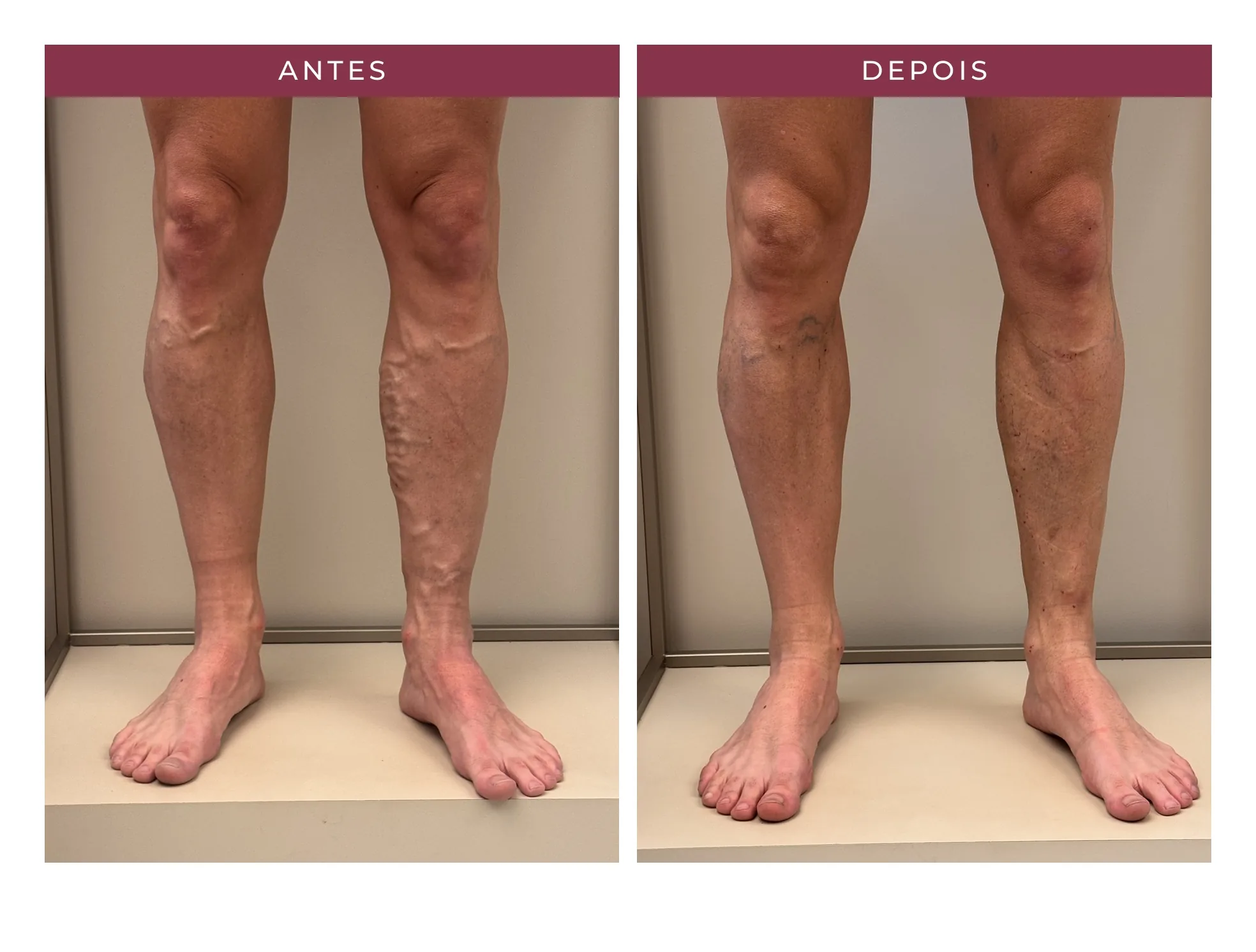 Paciente Luiz — antes e depois, ângulo 2