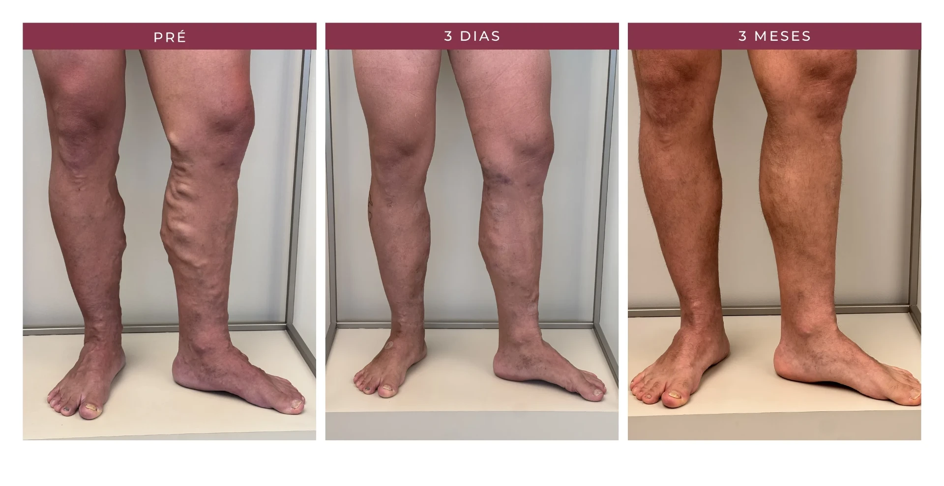 Paciente Marcos — pré, 3 dias e 3 meses, ângulo 4