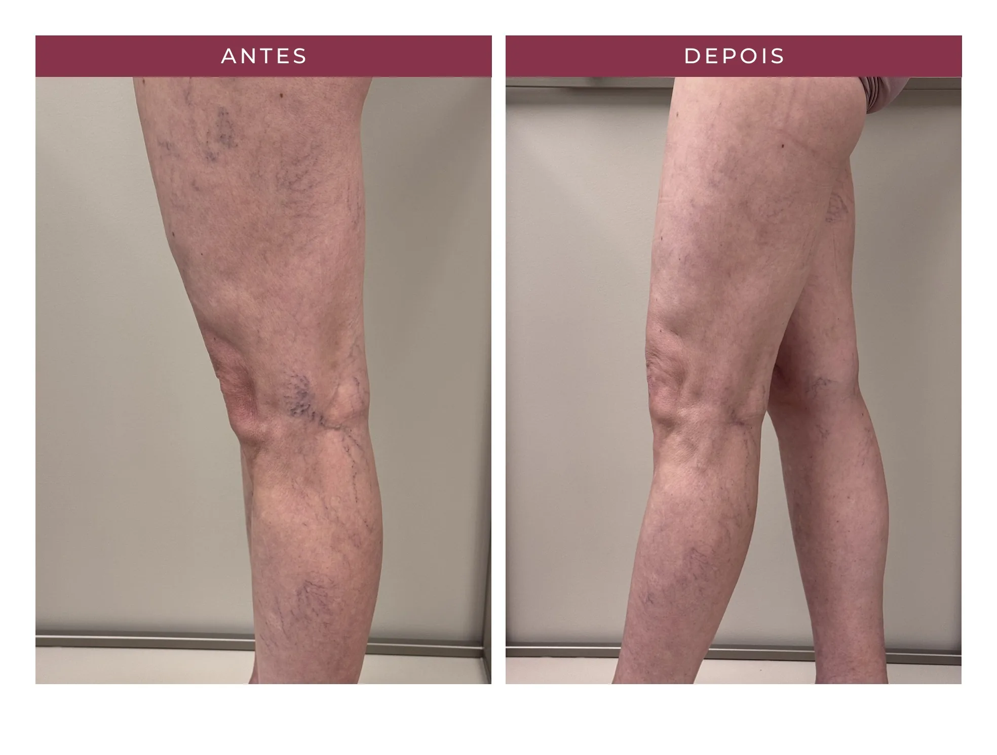 Paciente Eliene — antes e depois, ângulo 3