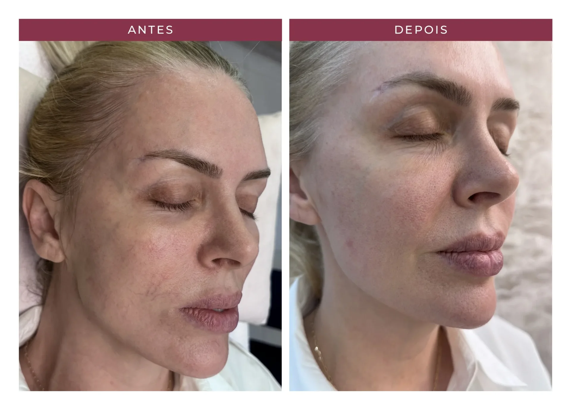 Tratamento de vasinhos da face — antes e depois