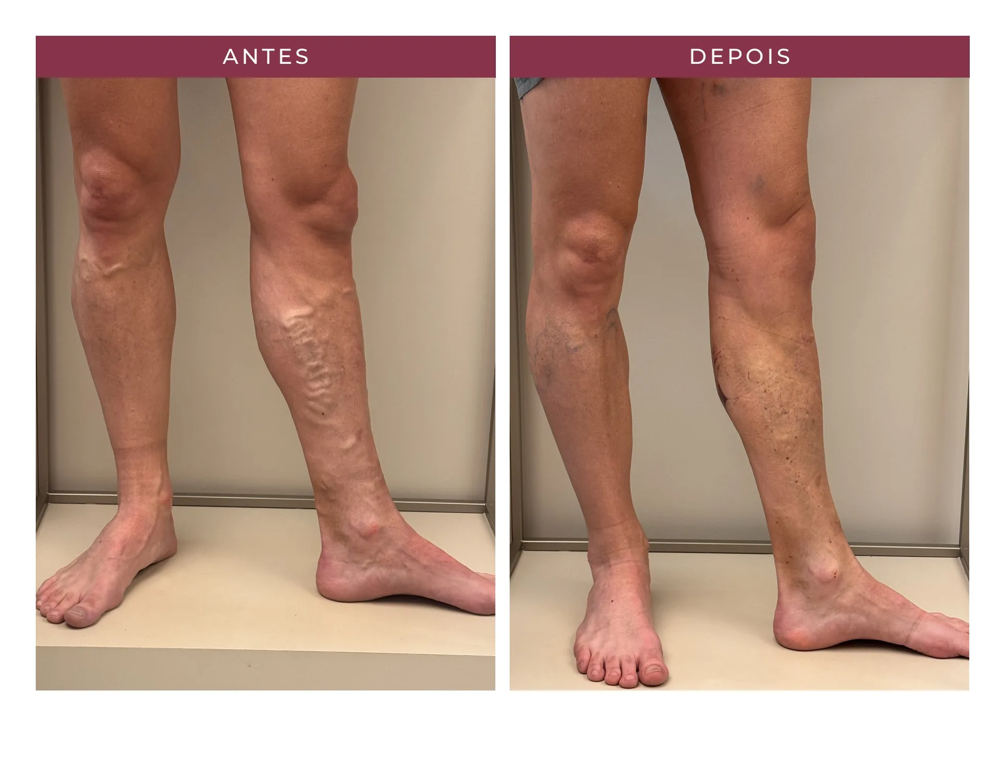 Paciente Luiz — antes e depois, ângulo 3