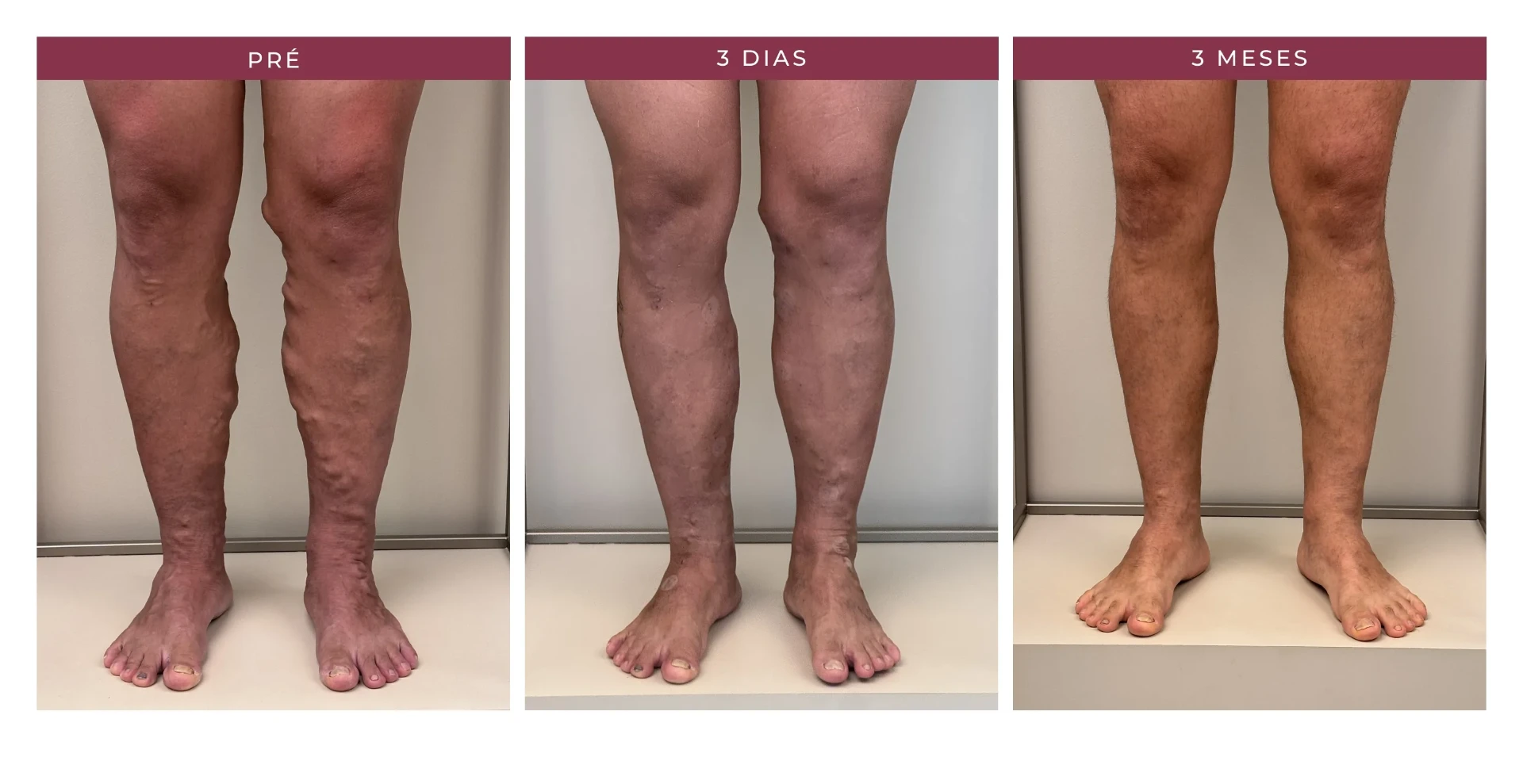 Paciente Marcos — pré, 3 dias e 3 meses, ângulo 2