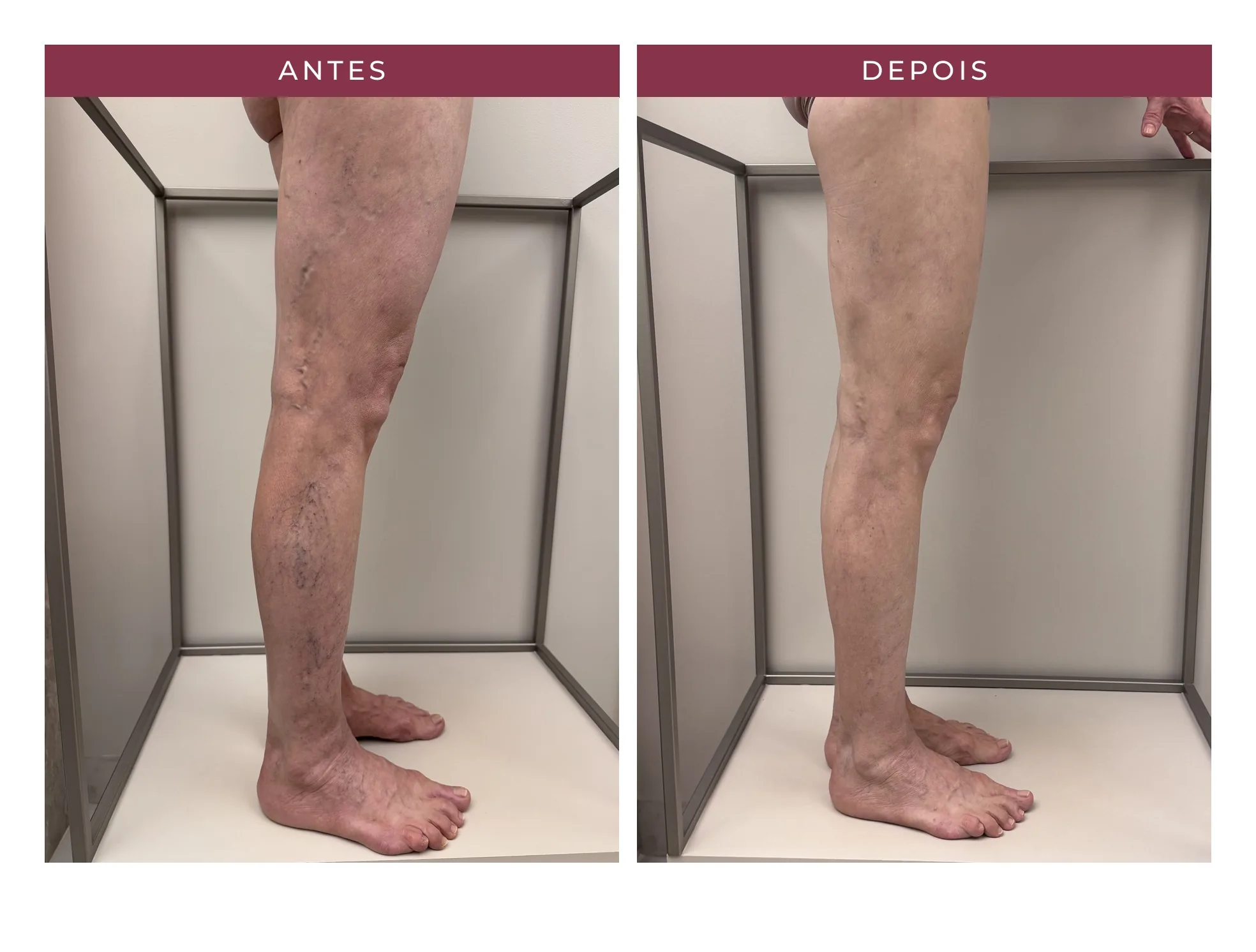 Paciente Eliene — antes e depois, ângulo 1