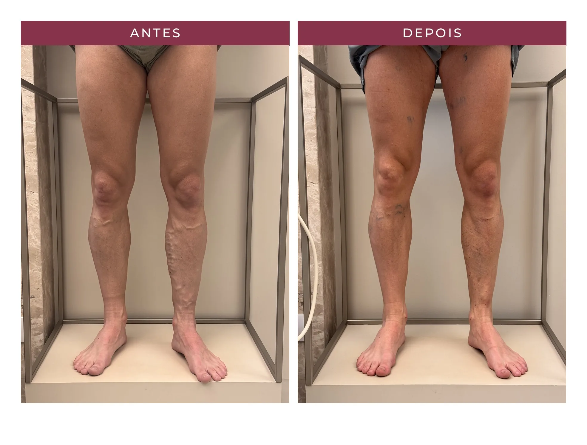 Paciente Luiz — antes e depois, ângulo 1